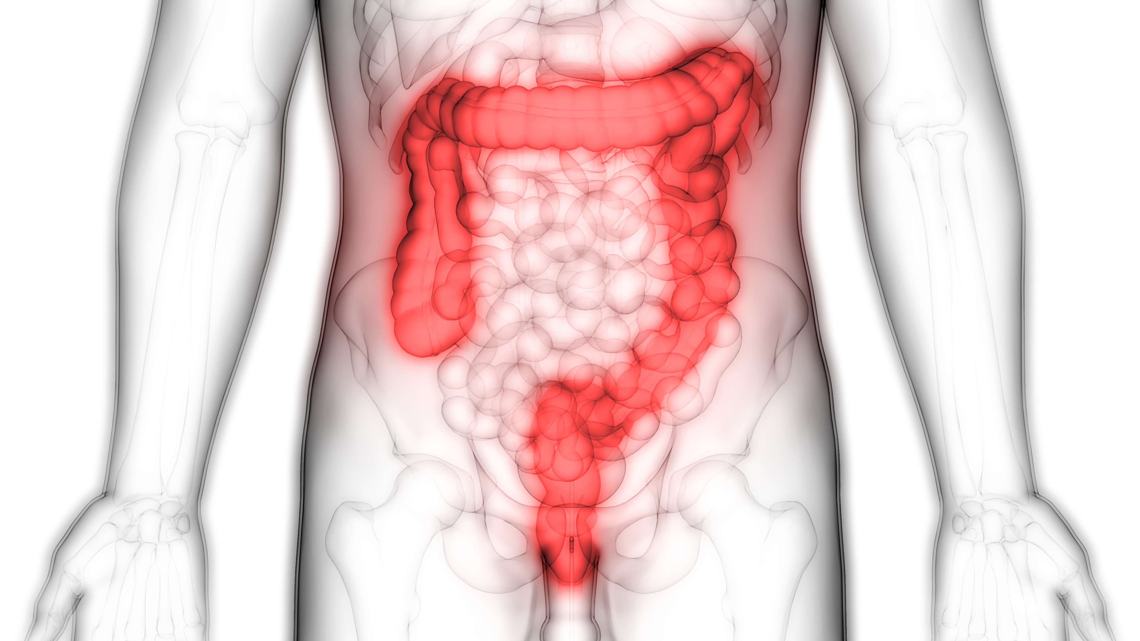 Distinct gut microbiome patterns associate with different subtypes of colorectal cancer